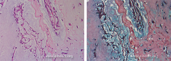 Atrial myxoma H&E & Movat